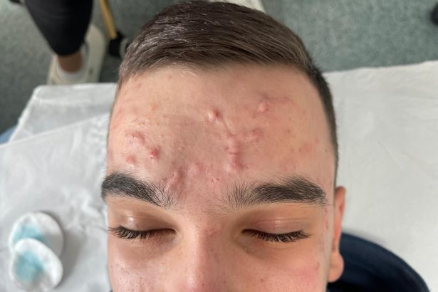 Clinica ALTEO Bistrita Solutii personalizate pentru acneea si un ten curat sanatos