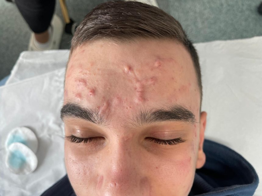 Clinica ALTEO Bistrita Solutii personalizate pentru acneea si un ten curat sanatos